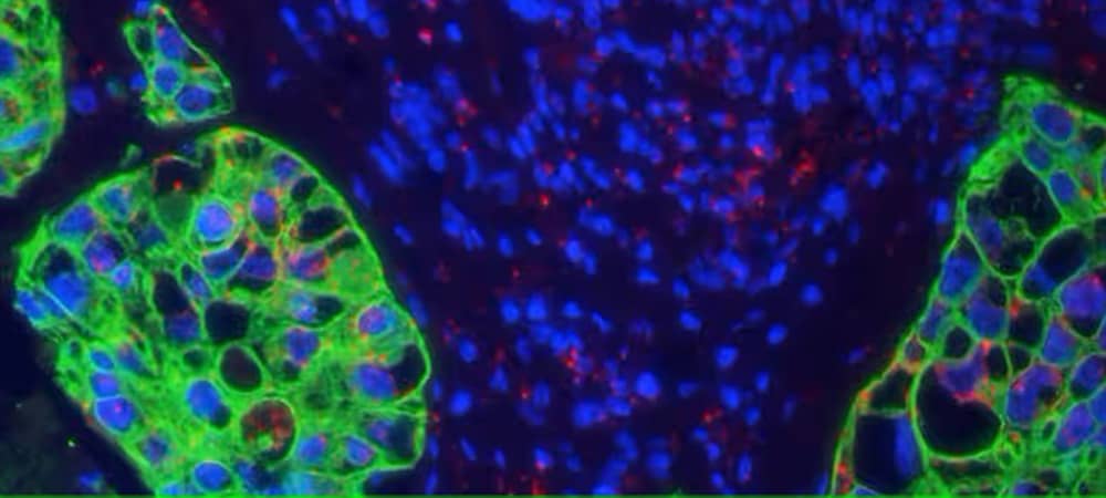 Image showing dual ISH-IHC staining in human lung cancer with human PPIB positive control mRNA probe in red, CAM5.2 acidic cytokeratin immunohistochemical staining in green with DAPI as counterstain.