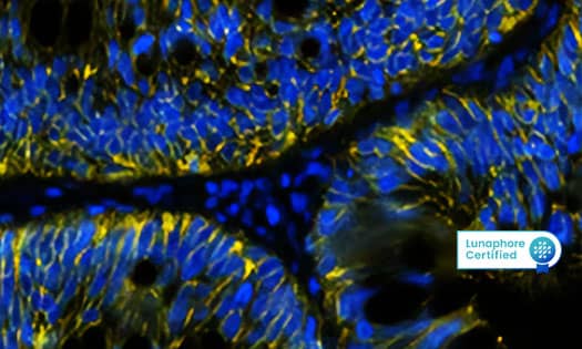 Detection of Cadherin in human colon cancer via Multiplex Immunofluorescence on COMET™