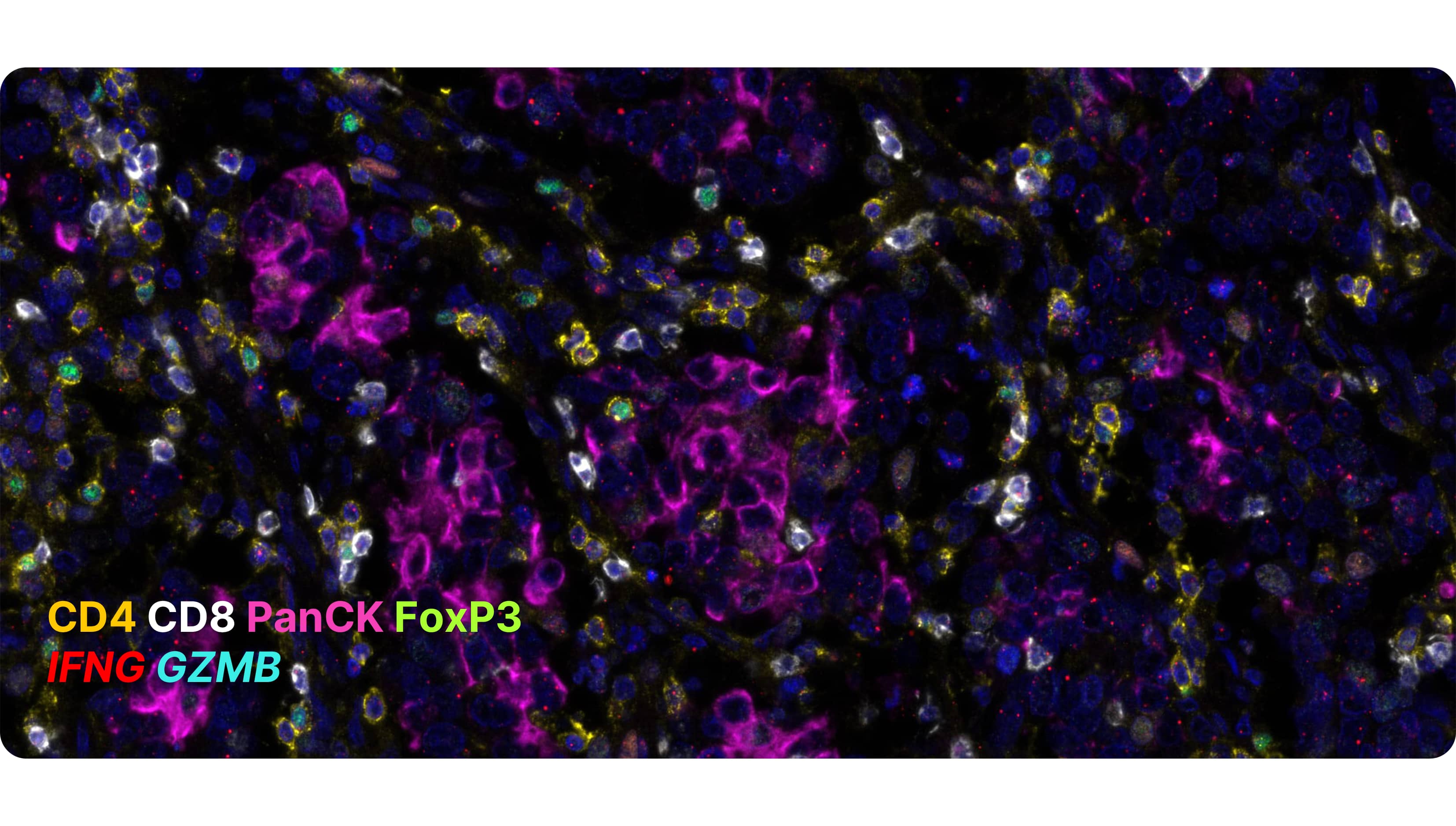 Detection of 4 marker proteins using RNAscope human T-cell antibody panel: CD4 (yellow), CD8 (white), PanCK (purple), FoxP3 (green); 2 target RNAs IFNG (red) and GZMB (blue) in human breast cancer. CD8 and GZMB coexpression indicates activated T-cells.