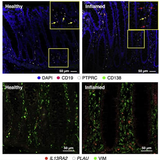 OSM and OSMR expressions by MHCII+ myeloid cells and inflammation-associated fibroblasts (IAF) 