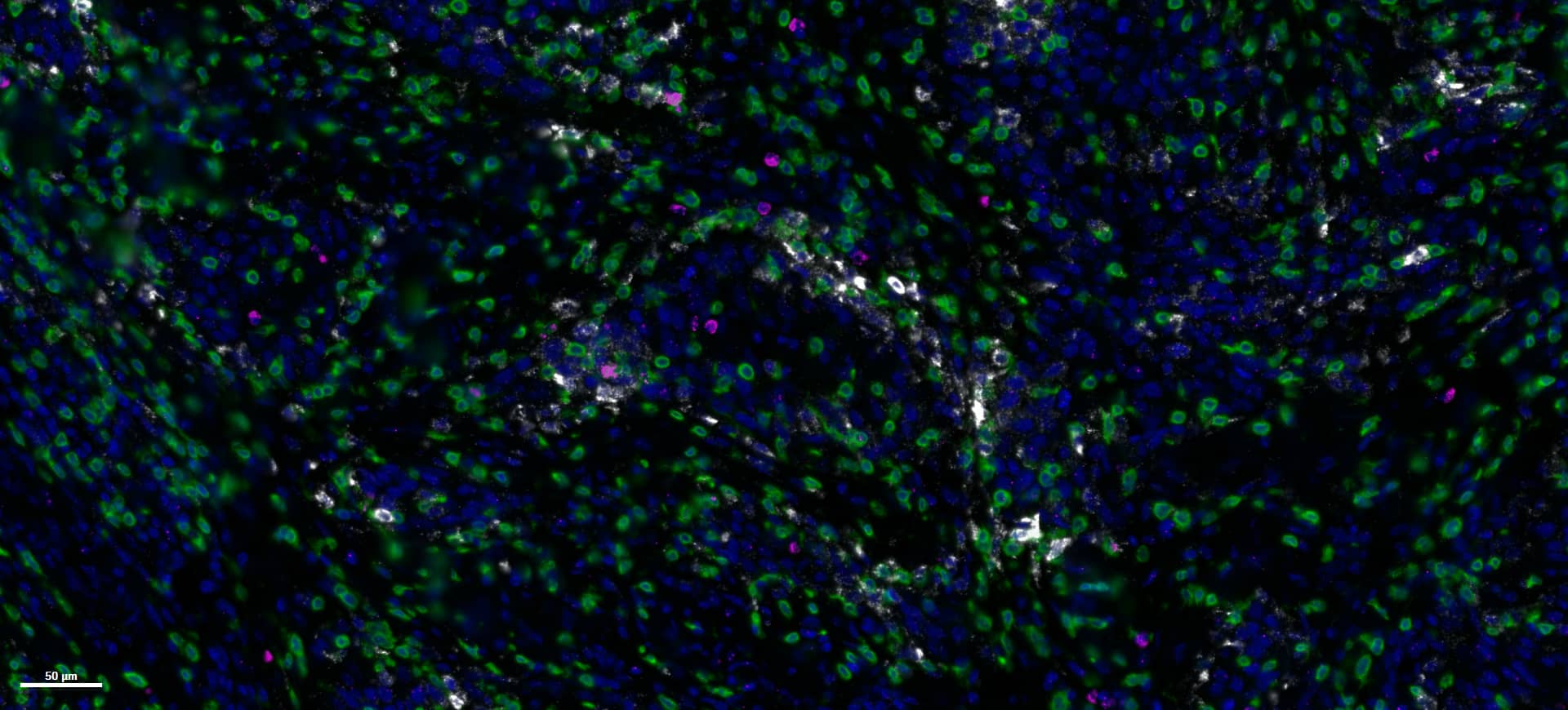 RNAscope™ Fluorescent Multiplex v2 Assay: FFPE tissue, human cervical cancer - CD3 protein (green) ifng RNA (pink), cxcl9 RNA (white)