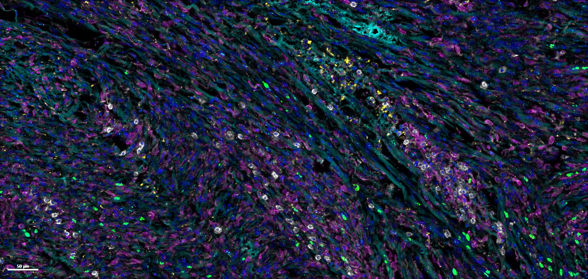 Detection of cytokines, immune and tumor cells using an RNAscope RNA-protein multiomic panel. Simultaneous detection of 3 marker proteins (CD8a, CD68, IBA-1) and 3 target RNA probes (CXCL2, IL6, and INFg) in brain TME. Nuclei were stained with DAPI.