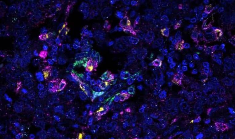 RNAscope multiomics image Mapping tumor associated M1/M2 macrophages  marked by CD163+ / CD68+ ,  IL1B+ / IL10+ in cervical cancer tissue