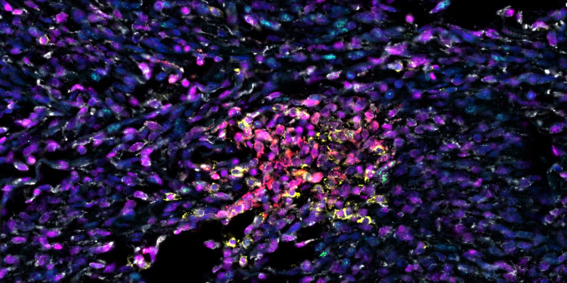 Profiling different cell types within the brain tumor microenvironment. Simultaneous detection of a panel of 3 marker proteins (CD8a, CD68, S100β) and 3 target RNA probes (CLDN5, CXCL10, TNFα) in brain tumor tissue.