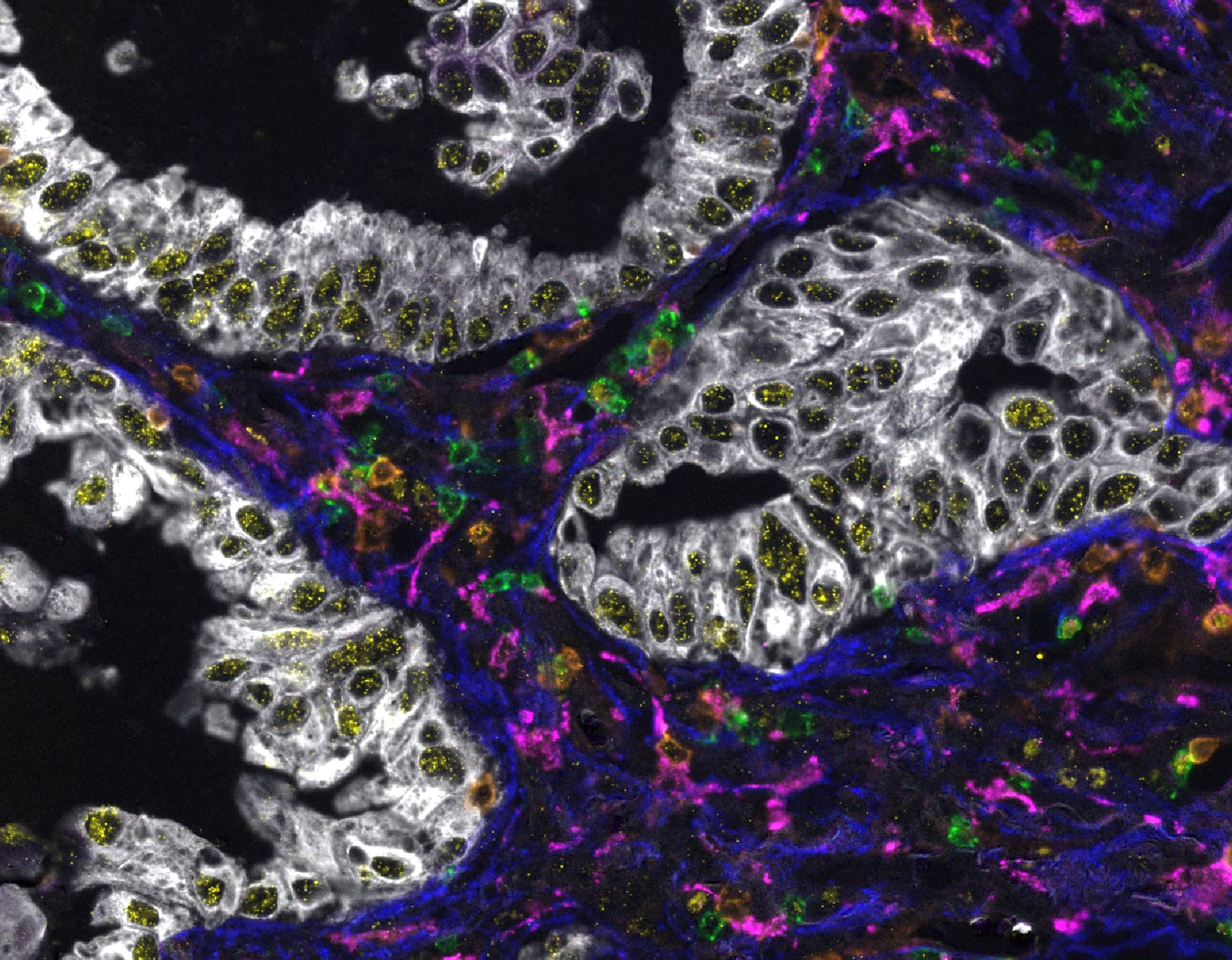 SITC 2025 Human Lung Cancer TMA - COMET