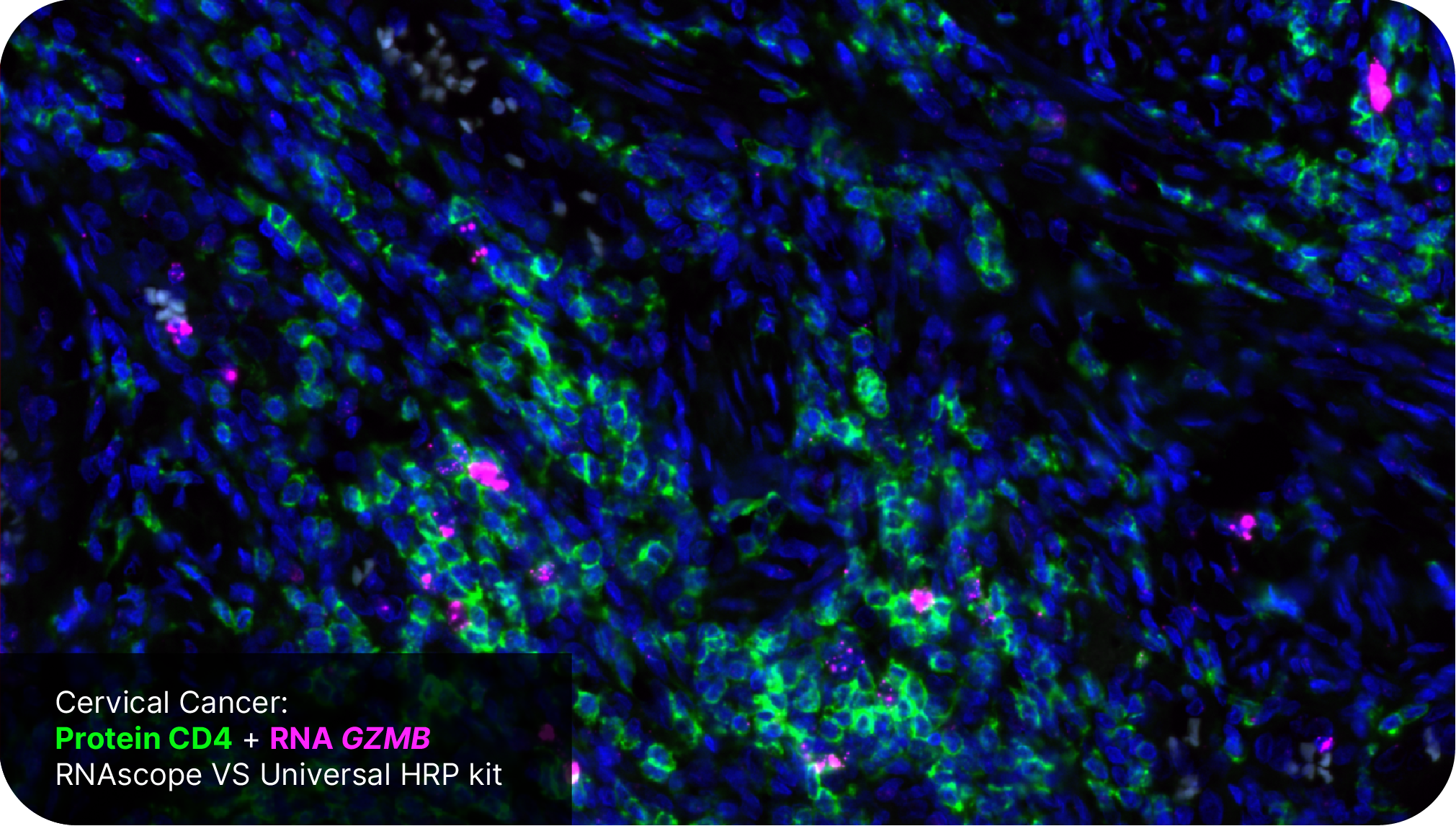 Protein CD4 + RNA GZMB - RNAscope VS Universal HRP Assay