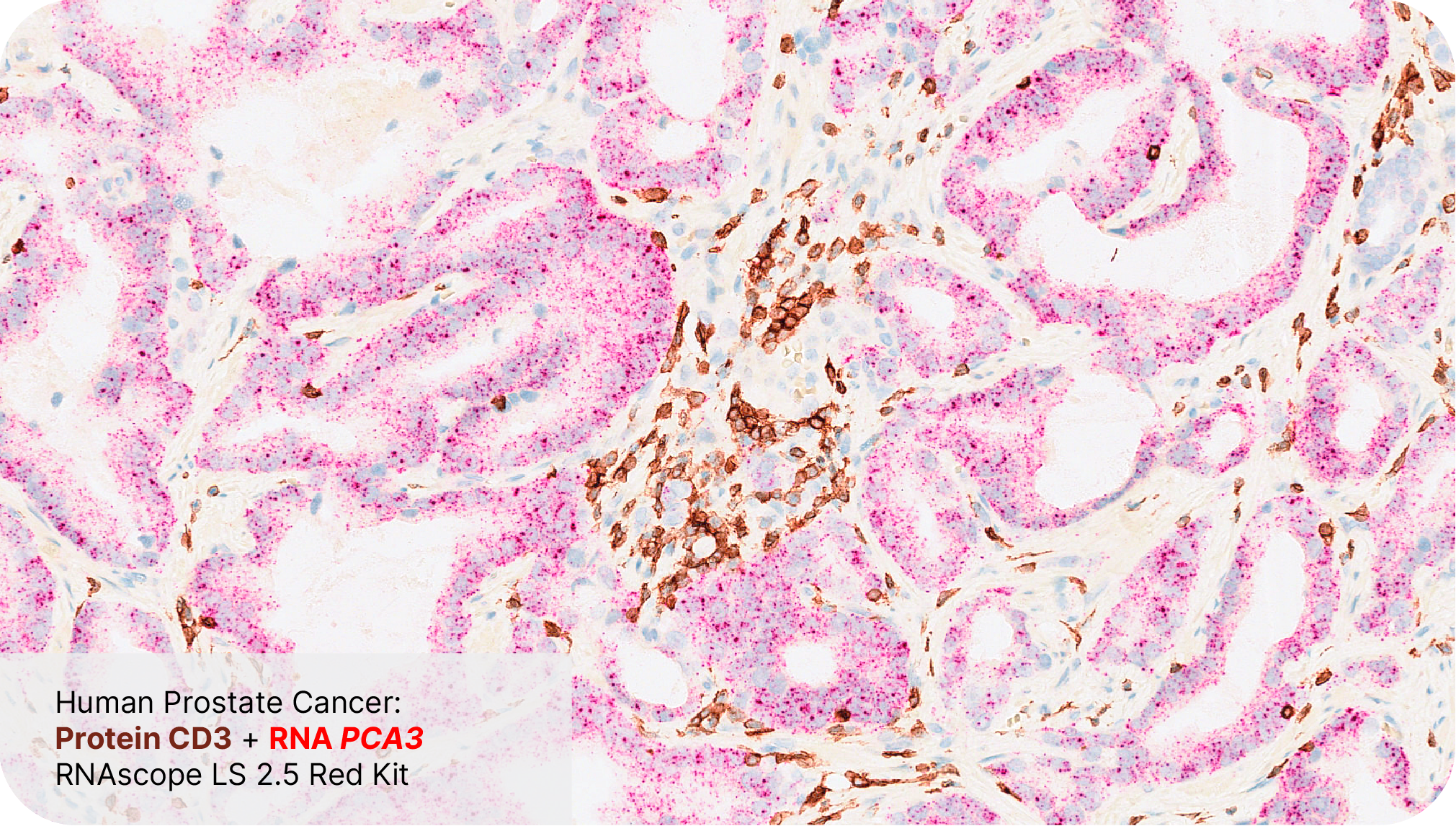 Protein CD3 + RNA PCA3 - RNAscope LS 2.5 Red Assay