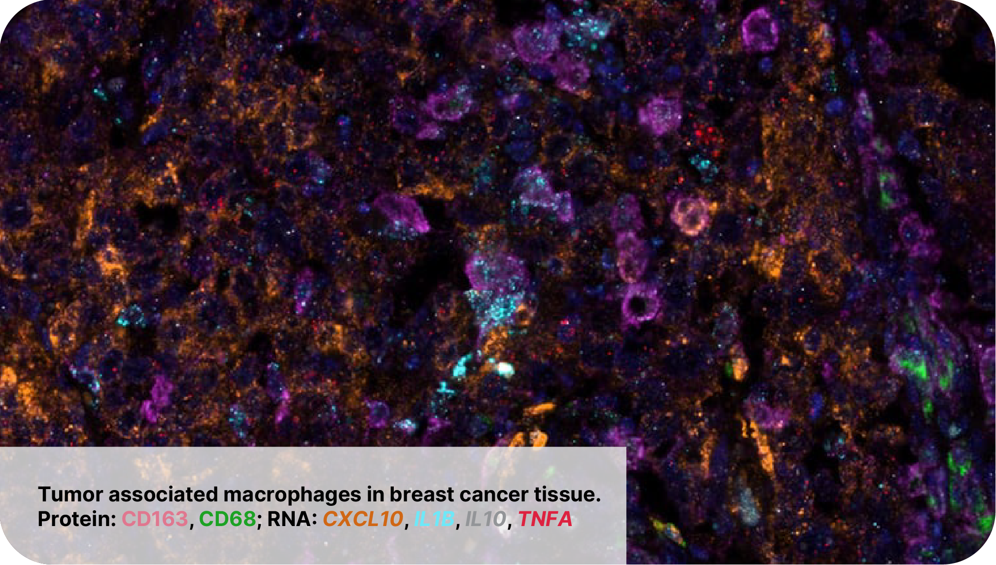 RNAscope image showing Tumor Associated Macrophages in Breast Cancer