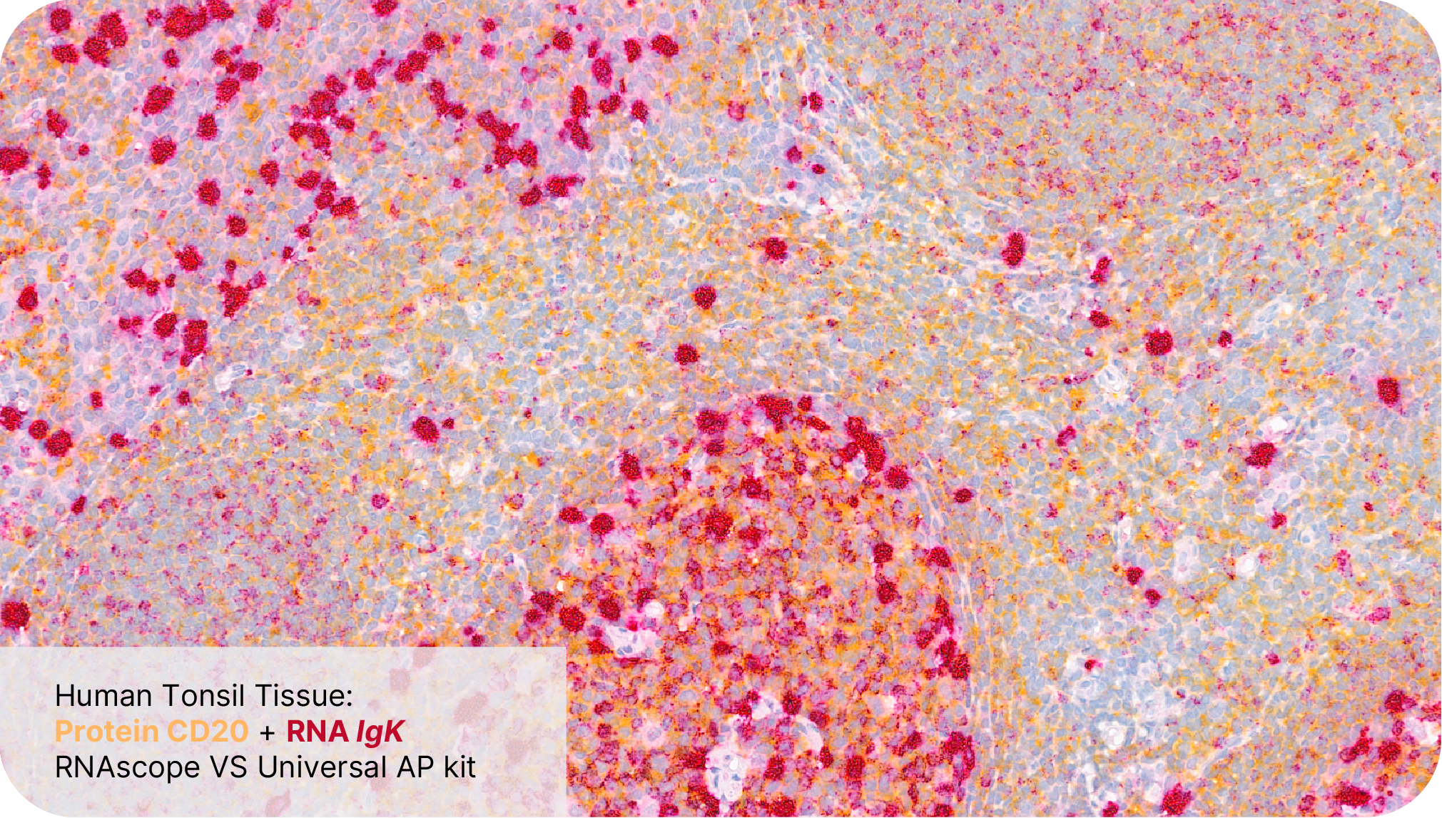 Protein CD20 + RNA IgK - RNAscope VS Universal AP Assay