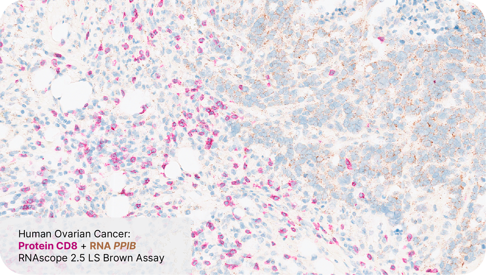 Protein CD8 + RNA PPIB - RNAscope 2.5 LS Brown Assay