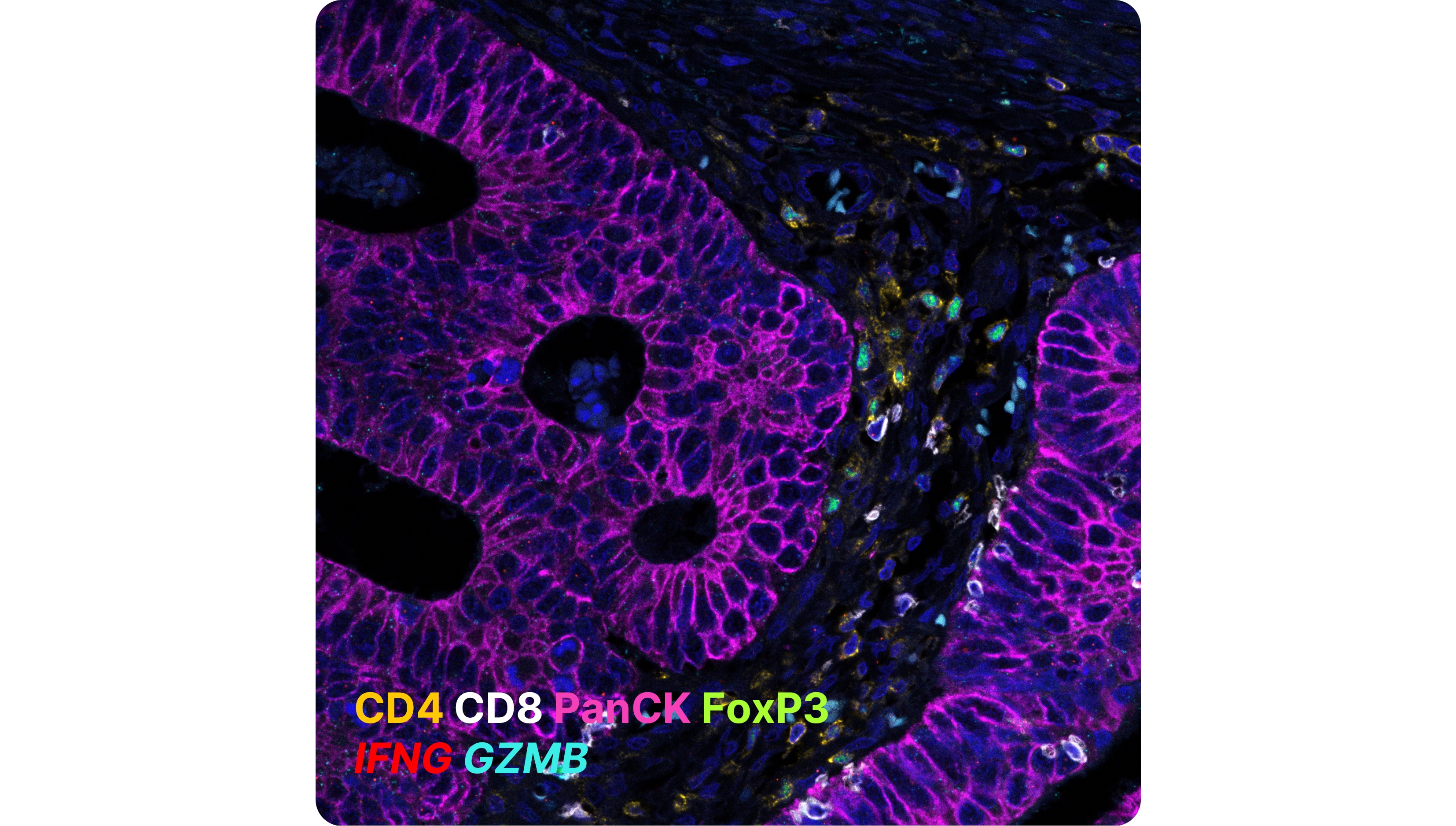 Detection of cytokines, immune and tumor cells in colon cancer tissue using RNAscope RNA-protein multiomic panel comprising 4 marker proteins: CD4 (yellow), CD8 (white), PanCK (purple), FoxP3 (green); 2 target RNA probes IFNG (red), GZMB (blue).