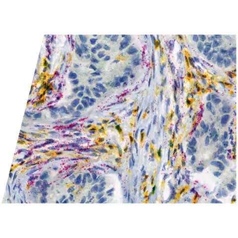 rnascope-ventana-red-teal-human-tumor