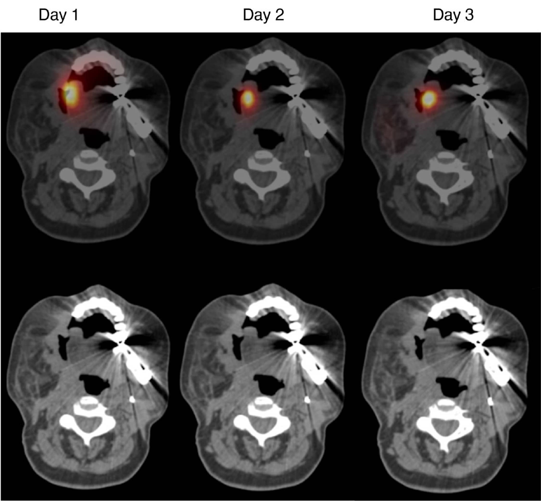 SPECT-CT imaging of radiolabeled T4 CAR T cells