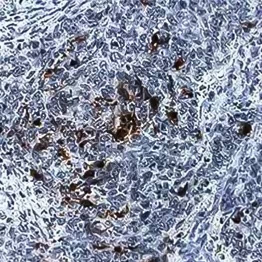 Immunohistochemical analyis of Caspase-3 (active) expression in human colon cancer tissue with tissue stained using DAB (brown) and counterstained with hematoxylin (blue).