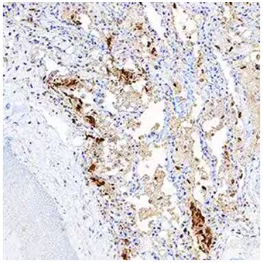 Immunohistochemical staining of human lung tissue with SARS Nucleocapsid antibody followed by HRP-conjugated secondary antibody, DAB chromogen, and counterstained with hematoxylin.