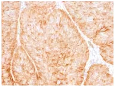 Immunohistochemical staining of formalin-fixed, paraffin-embedded human bladder carcinoma cells with mouse monoclonal Glut1 antibody.