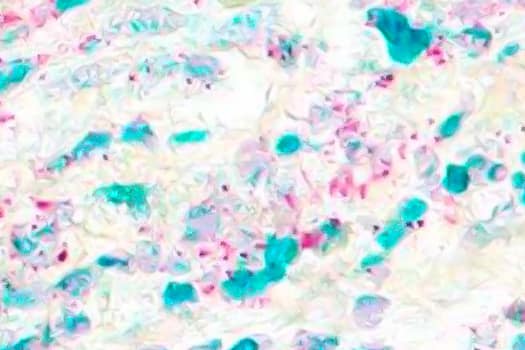 Dual RNAscope ISH-IHC analysis following ACD’s Integrated Co-Detection Workflow using Rabbit anti-FOXP3 Polyclonal Antibody and ACD RNAscope Probe Hs-CD4 for detection of protein (green) and mRNA (red), respectively.