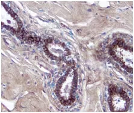 Immunohistochemical staining showing MICA expression in immersion-fixed paraffin-embedded breast cancer tissue sections using Goat Anti-MICA Polyclonal Primary Antibody and stained with HRP-DAB Kit (brown) and counterstained with hematoxylin (blue).