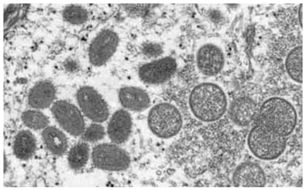 Electron microscopy image of immature and mature monkeypox viral particles in human skin.