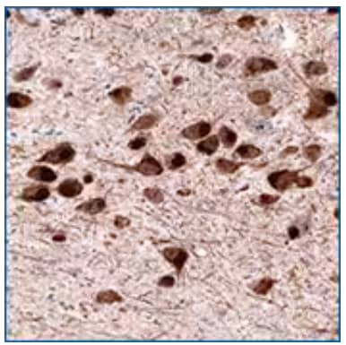 Dopamine D1 receptor expression in human brain caudate nucleus, IHC