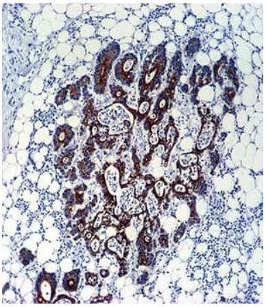 TGF-beta 2 expression in colon carcinoma IHC