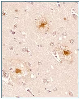 beta amyloid expression in human Alzheimer’s hippocampus, IHC