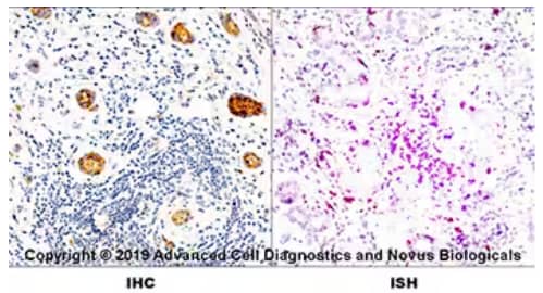 Dual RNAscope ISH-IHC of FFPE-tissue sections of human metastatic tonsil probed for HLA-DR mRNA (right) and Anti-HLA-DR Antibody, followed by HRP polymer antibody and DAB chromogen (left), and tissue counterstained with hematoxylin.