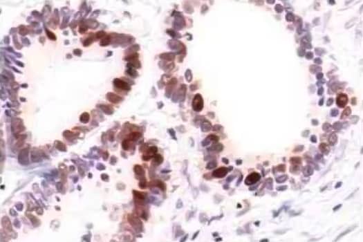 Immunohistochemical analysis of PCNA expression in human colon carcinoma with nuclear localization in brown.