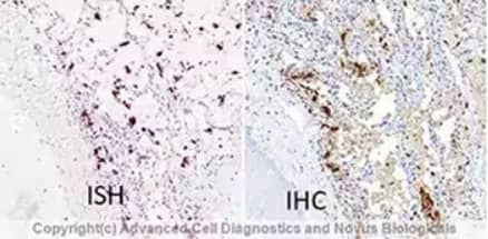 Dual RNAscope ISH-IHC of FFPE-tissue sections of SARS-CoV-2 infected human lung tissue probed for SARS-Cov-2 viral RNA (left) and anti-SARS Nucleocapsid Antibody (right) followed by anti-IgG HRP polymer antibody and DAB chromogen, then counterstained with