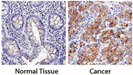 Immunohistochemical analysis showing PD-L1 expression in immersion-fixed paraffin embedded tissues from normal colon and colon cancer samples detected using Goat Anti-Human PD-L1/B7-H1 Polyclonal Antibody, followed by staining with HRP-DAB IHC Staining Ki