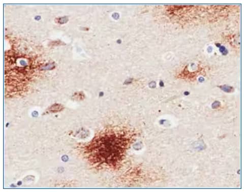 APP expression in human Alzheimer’s disease hippocampus tissue, IHC, immunohistochemistry, citrate buffer antigen retrieval, parahippocampal gyrus staining