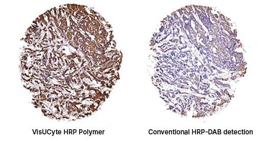 Immunohistochemical analysis of staining in human breast cancer tissue detected with VisUCyte Detection Kit which produced strong, robust staining.