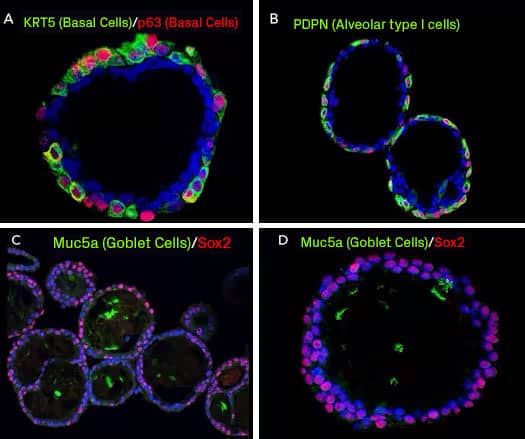 Human lung organoids grown in Cultrex UltiMatrix RGF BME and stained for Cytokeratin 5, p63, Podoplanin, Muc5a, and SOX2.