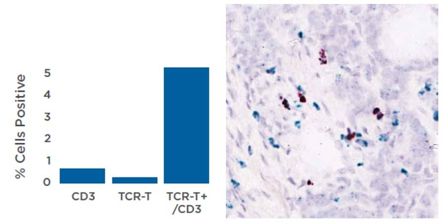 liposarcoma infiltration