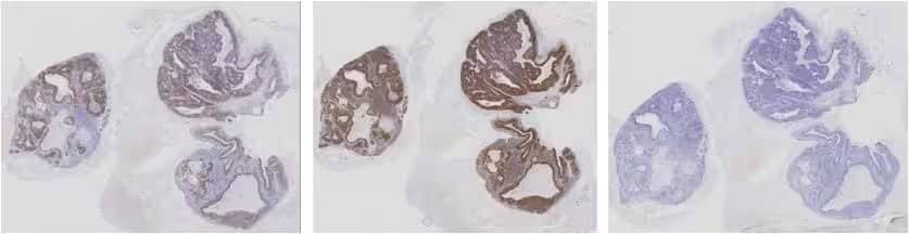 Image showing RNAscope assay results comparing a high expressing HR-HPV case study with a positive and a negative control.