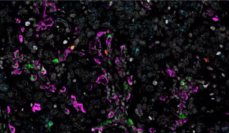 RNAscope multiomic LS assay image showing human breast cancer tissue stained for 2 protein targets (CD68 and CD163) and 4 RNA targets (IL10, IL-1B, TNFα, and CXCL10).