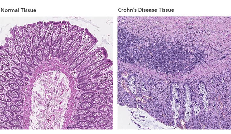 Identifcation of changes in target expression patterns with RNAscope in normal and Crohn’s disease tissue. 