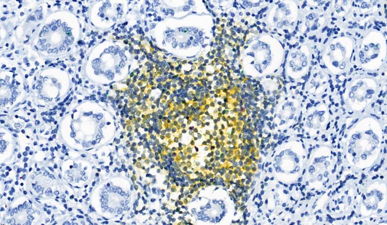 RNAscope chromogenic assay image in colon cancer tissue