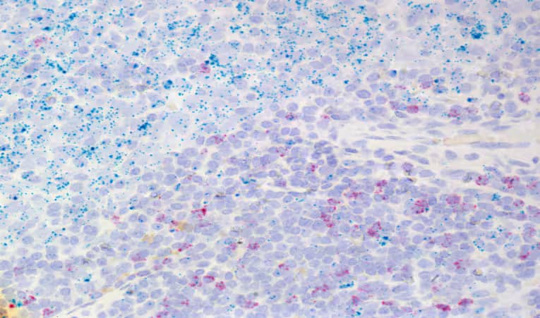 RNAscope 2.5 HD Duplex Assay: FFPE tissue, human lung cancer  - CD274 RNA (green) and CD8A RNA (red)