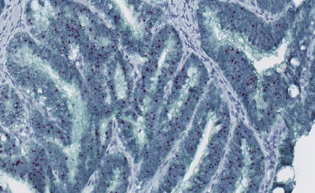 RNAscope chromogenic assay image of cervical cancer tissue