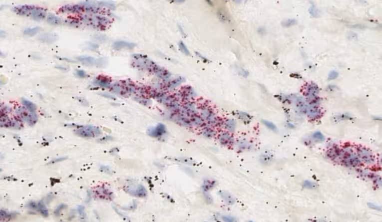 RNAscope duplex chromogenic assay in colon cancer tissue