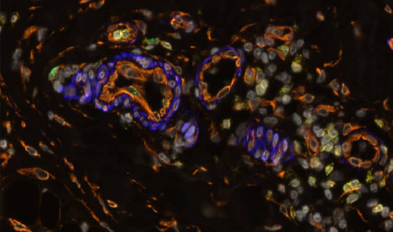 Multiomics on COMET​: FFPE human breast cancer​ RNA: IL6 (green)​ Protein: CD3 (yellow), Vimentin (orange), aSMA (blue)