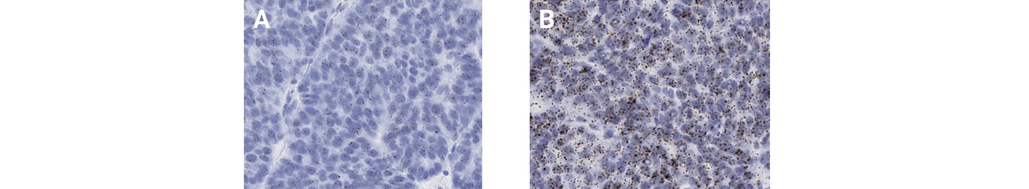Image showing homogeneous expression of MICA (A) and MICB (B) in human ovarian cancer tissue using the RNAscope 2.5 HD BROWN assay