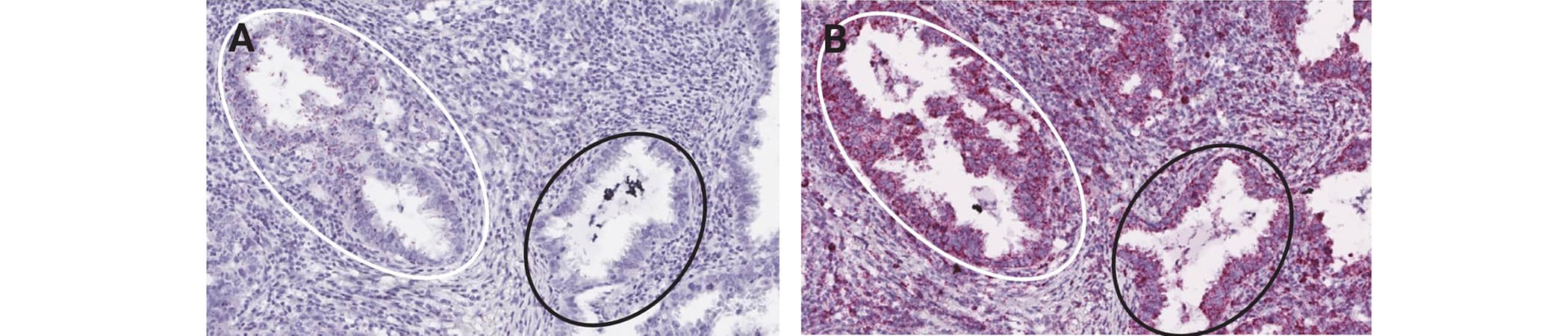 RNAscope 2.5 HD RED assay showing heterogeneous expression for AFAP1-AS1 (A) and positive control staining (B) in human lung cancer tissue