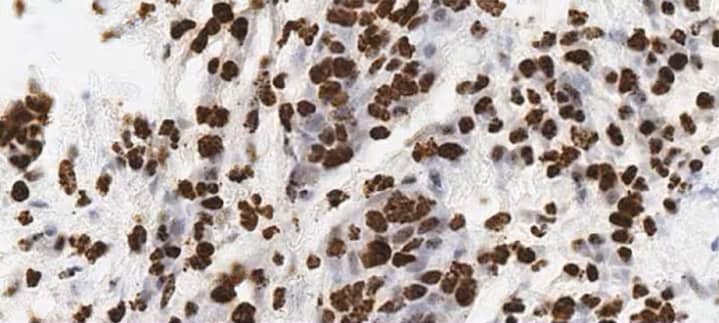 RNAscope 2.5 HD BROWN assay showing subcellular expression of MALAT1 in lung cancer