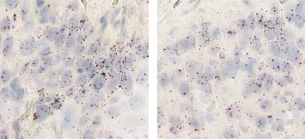 Co-expression of the NRG1 ligand (brown) and the ERBB3 receptor tyrosine kinase (red) in esophageal tumor cells using the RNAscope 2.5 LS Duplex assay.
