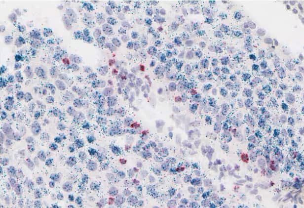 RNAscope 2.5 HD Duplex assay showing CD8-positive T cells (red) infiltrating a PD-L1-positive (green) tumor region in lung cancer