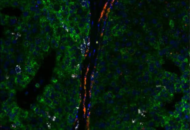 Multiplex expression of KRT19 (green), PECAM1 (red) and MKI67 (white) in human breast cancer using the RNAscope 2.5 LS Multiplex Fluorescent Assay