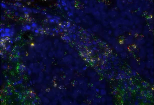 Figure 23. Multiplex expression of TGFβ1 (green), CD8A (yellow), CD4 (red) and TNFα (white) in human lung cancer using the RNAscope 2.5 LS Multiplex Fluorescent Assay