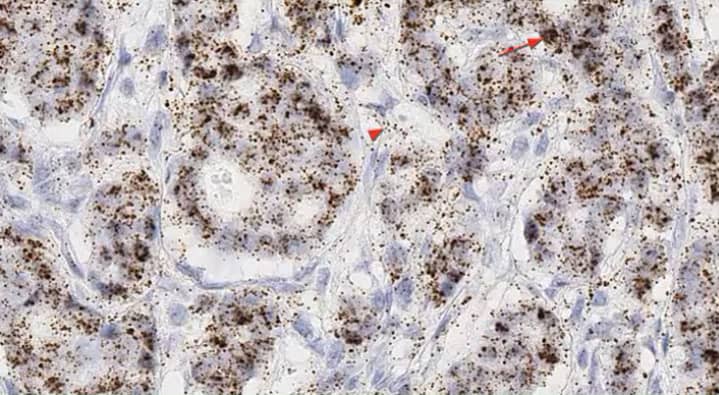 RNAscope 2.5 HD BROWN assay showing subcellular expression of GAS5 in breast cancer